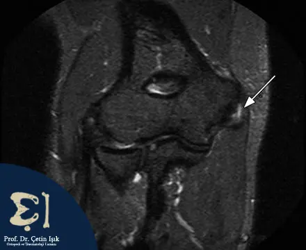 صورة رنين مغناطيسي (MRI) تبين التهاب اللقيمة الأنسية