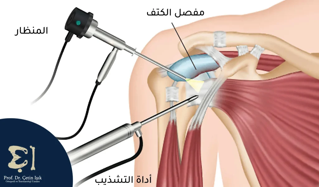 Shoulder arthroscopy to repair the skeletal structures of the joint