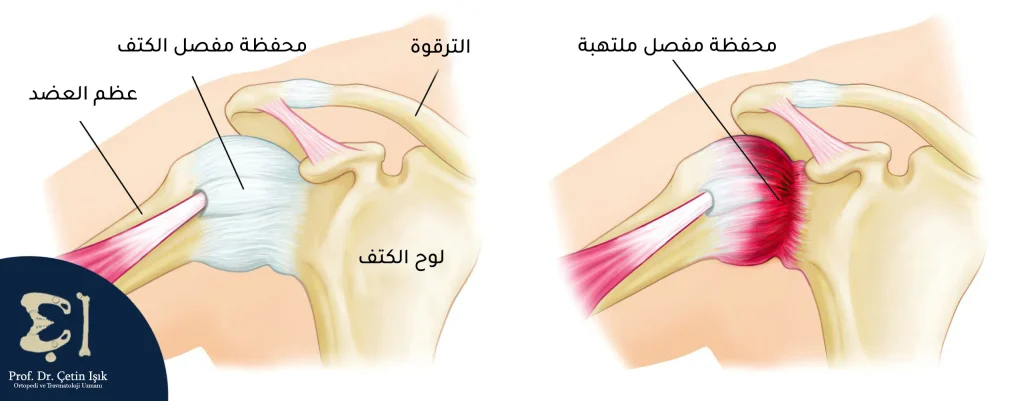 Frozen shoulder (capsulitis of the shoulder joint)