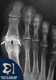 صورة شعاعية بسيطة (X-RAY) توضح التهاب مفاصل القدم