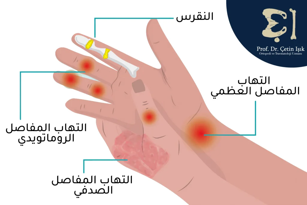 المفاصل المفضلة لكل نوع من أنواع التهاب مفاصل اليد