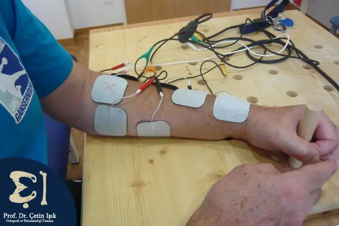 التحفيز الكهربائي الوظيفي (FES) من خلال وضع أقطاب كهربائية فوق العضلة، ثم ترسل الأقطاب نبضات كهربائية خفيفة إلى الأعصاب والعضلات لتحفيزها على التقلص