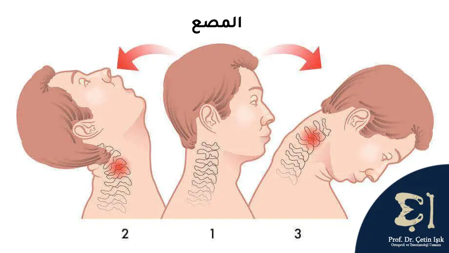 المصع وهو حركة مفاجئة للرقبة للأمام والخلف