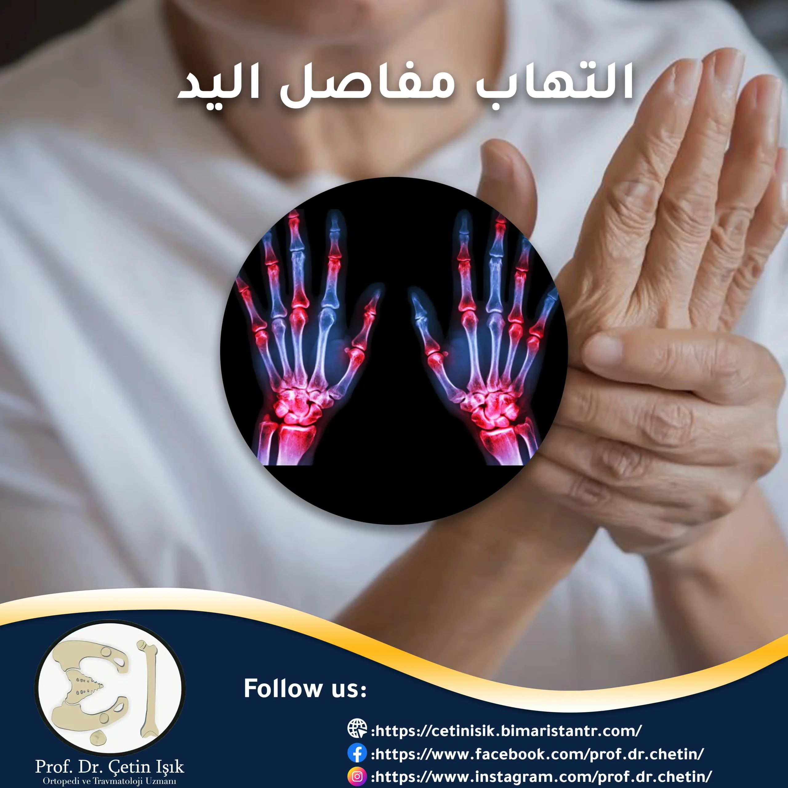 Hand arthritis, its types and treatment methods