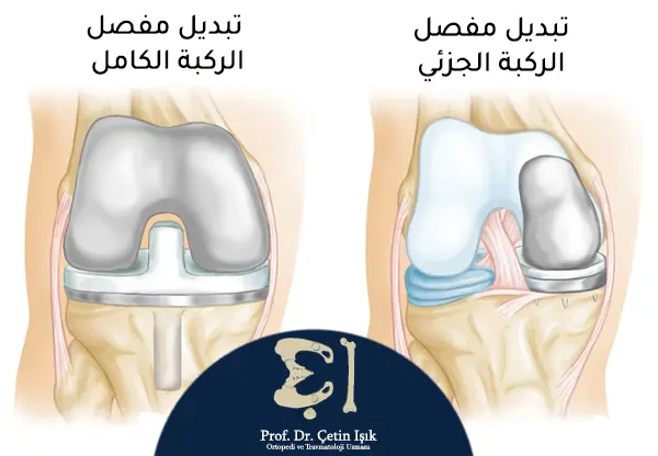 الفرق بين تبديل مفصل الركبة الكامل (جميع أجزاء المفصل) وتبديل مفصل الركبة الجزئي (الأجزاء المتضررة فقط)